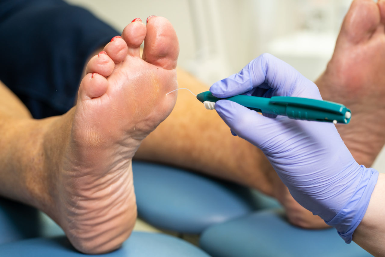 Diabetes and Foot Care: Tips for Preventing Complications